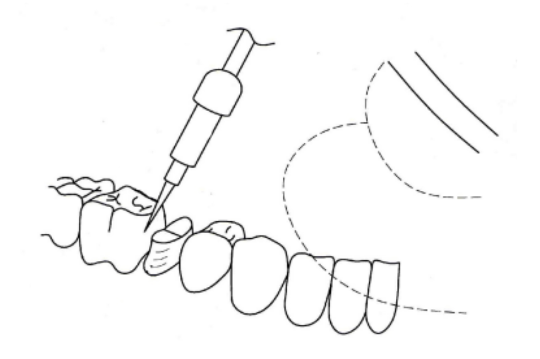 WriteFit® The Contact Marker